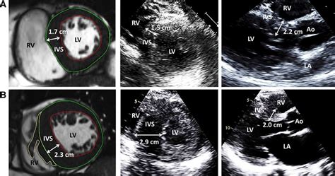 left ventricular thickness mri